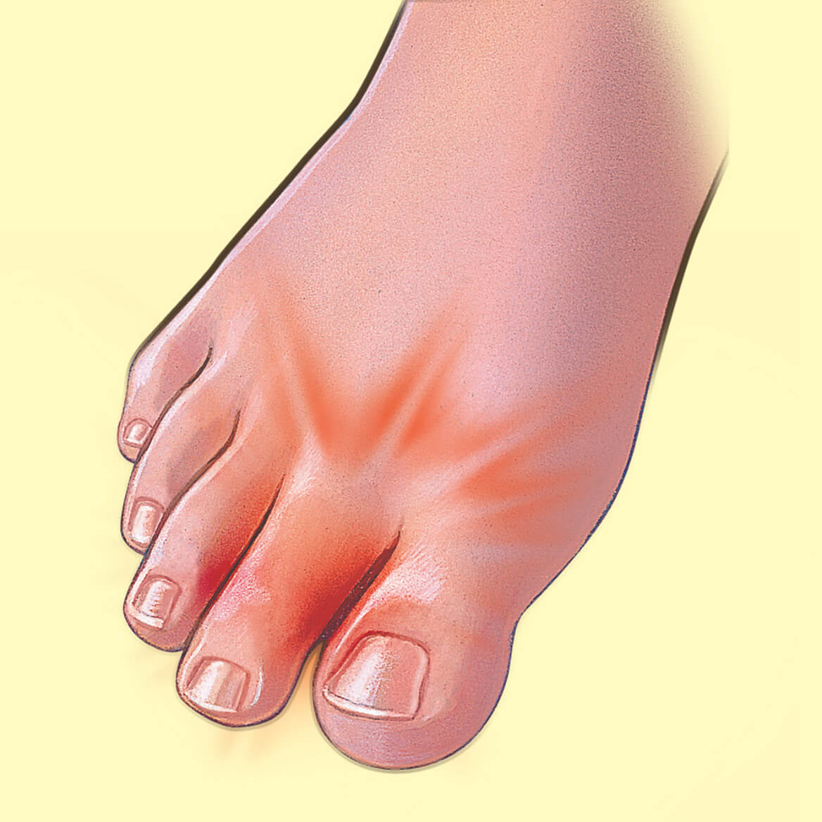 Gel Bunion Toe Wrap