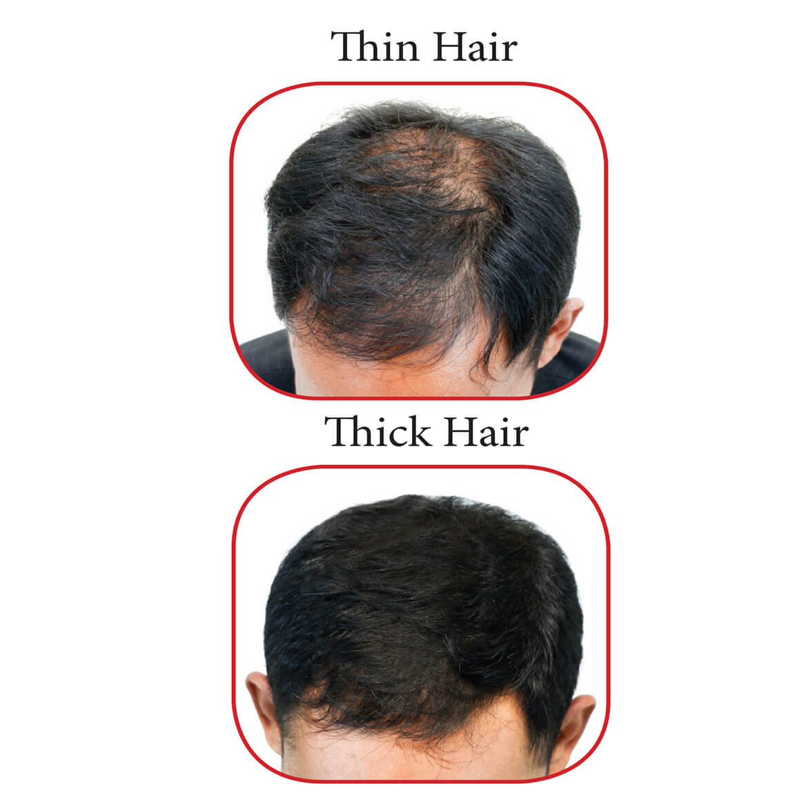 RemedyGrow Infrared Hair Growth Comb